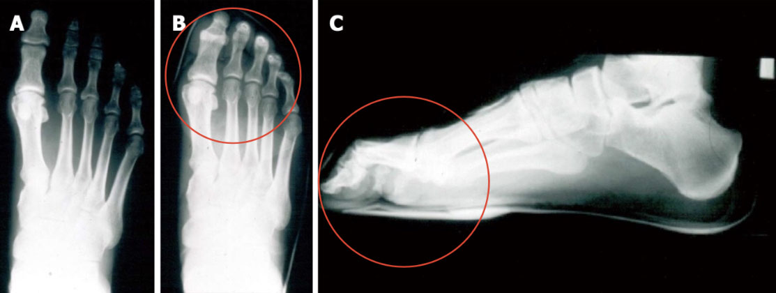 X-ray images of a foot inside a climbing shoe